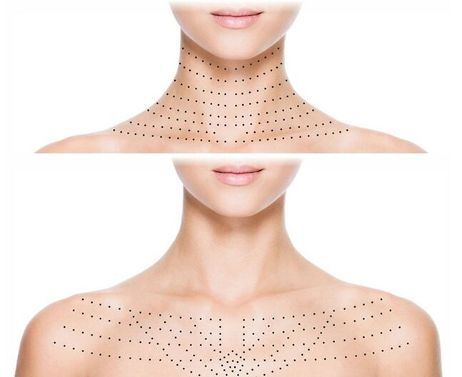Đánh dấu trên da cổ và ngực để trẻ hóa phục hồi sinh học