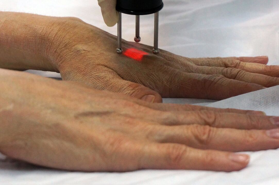 Trẻ hóa da tay bằng phương pháp không bóc tách