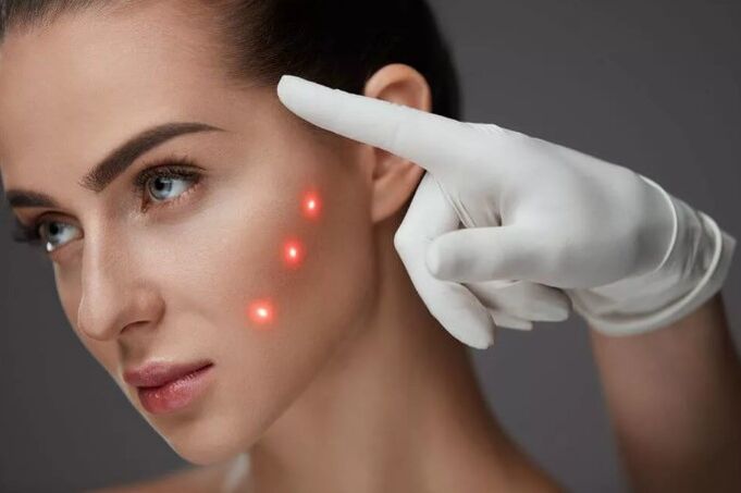 Trẻ hóa laser của da