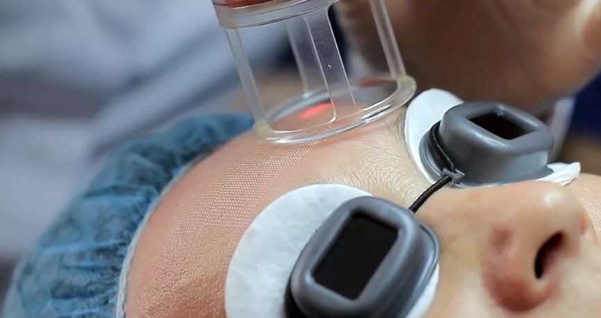 Laser hiện trường