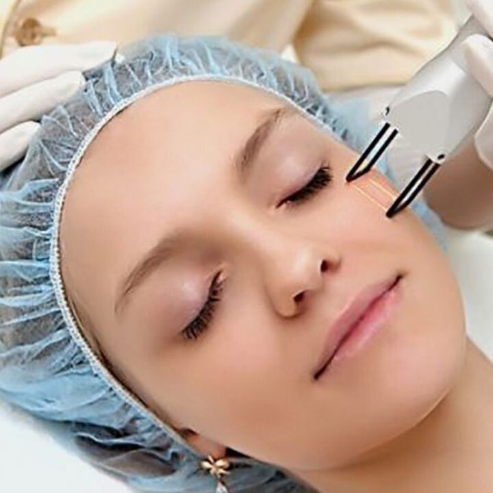 Trẻ hóa phân số laser
