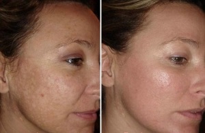 trẻ hóa da mặt bằng laser trước và sau ảnh